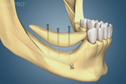 Mand Post Vertical Onlay as Separate Procedure